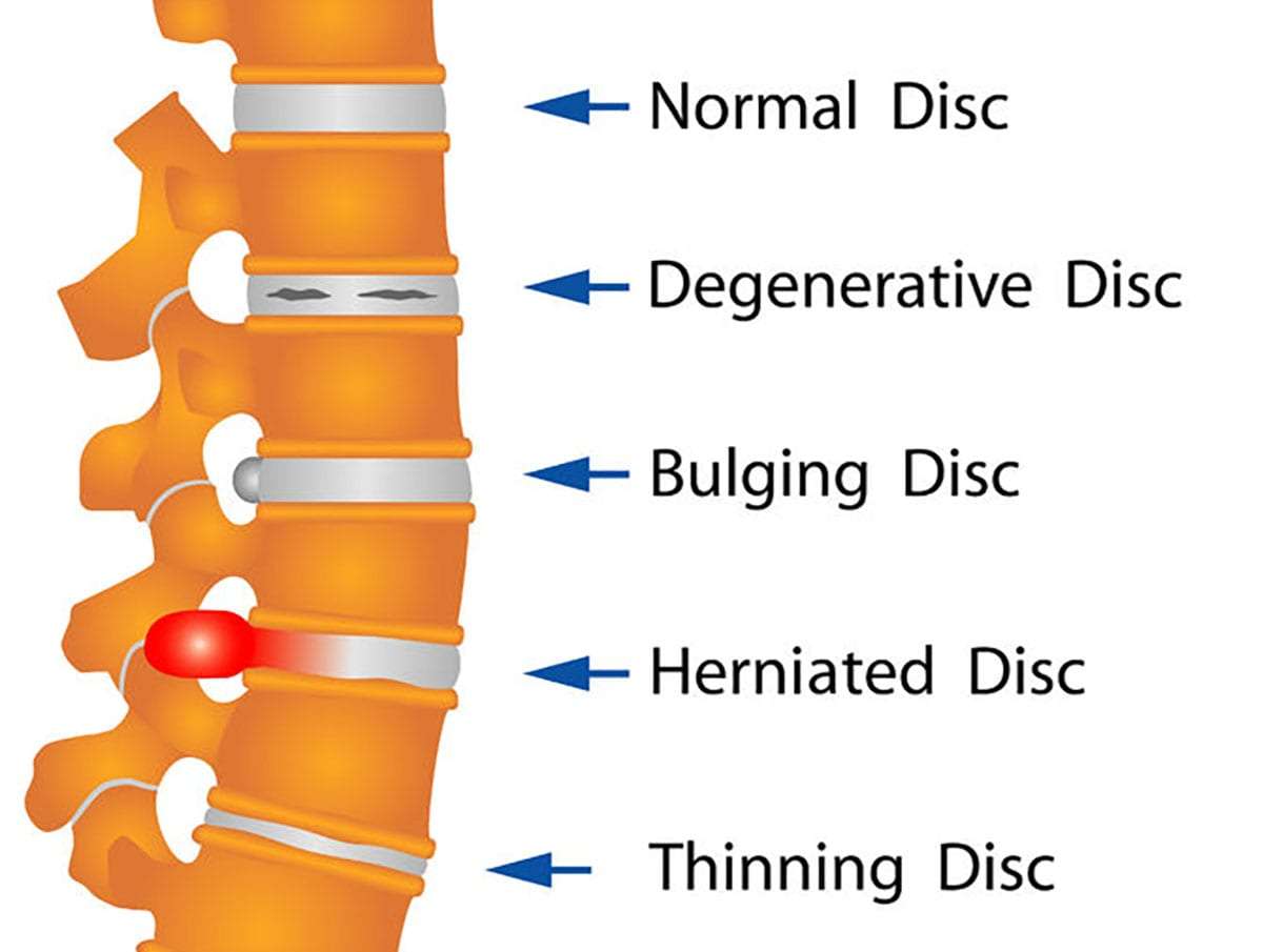 bulging discs image