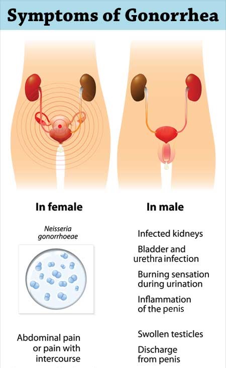 Symptoms of gonorrhea 