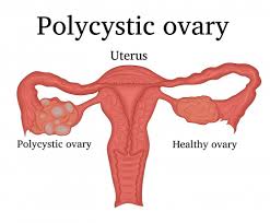 PCOS