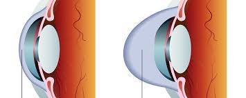 corneal ectasia image