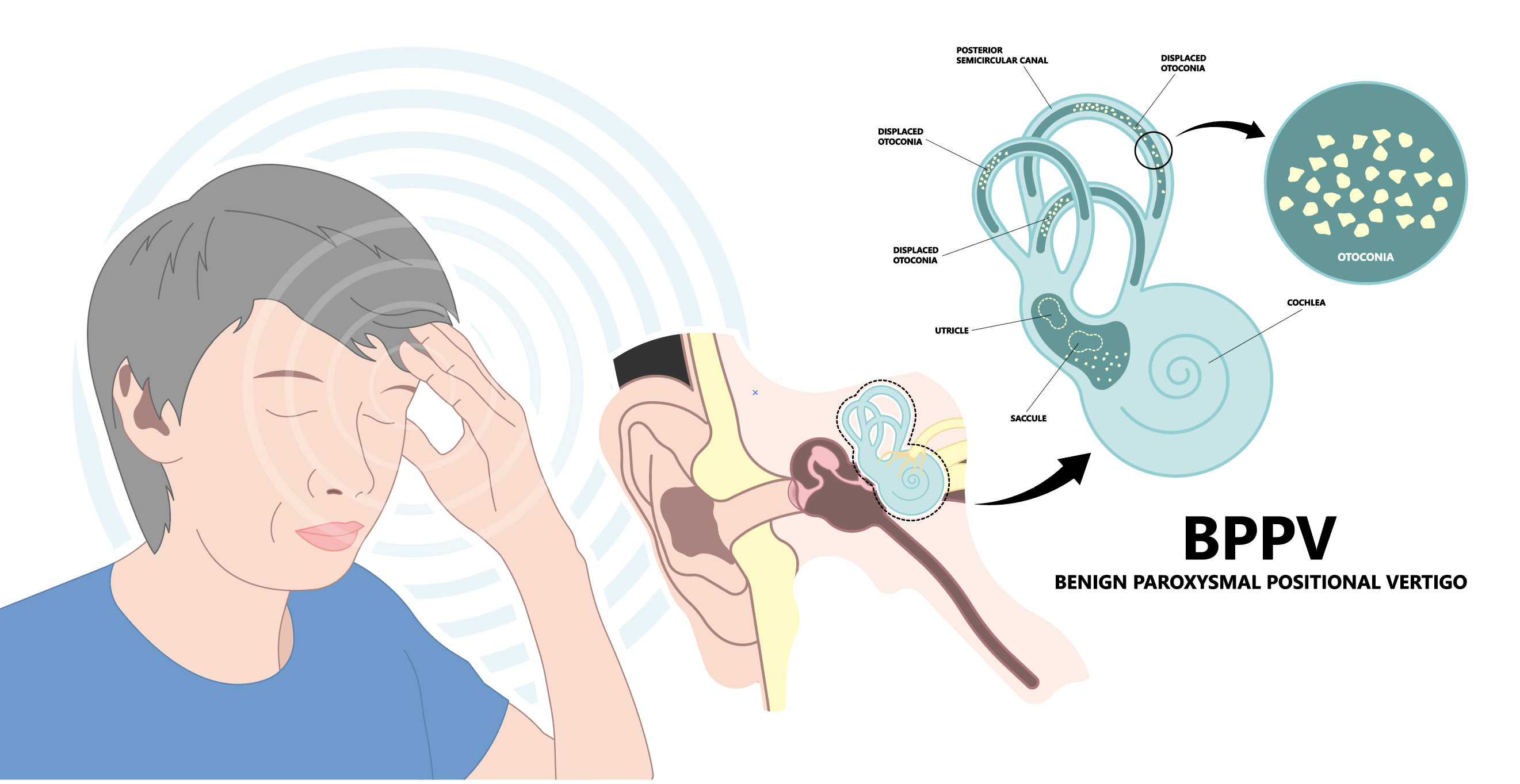 Benign Paroxysmal Positional Vertigo  Image