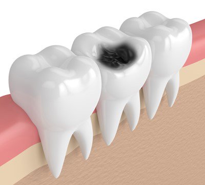 whole on teeth image