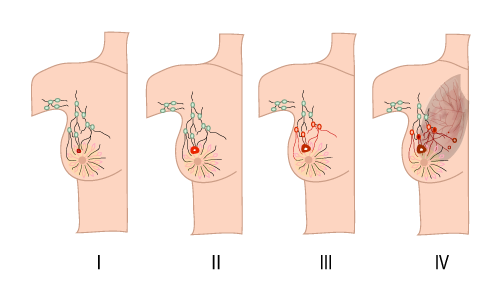 Breast Cancer Stages