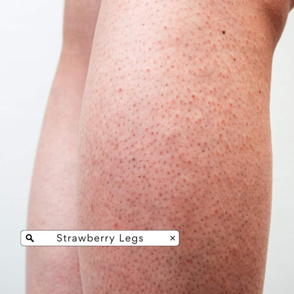 Strawberry legs