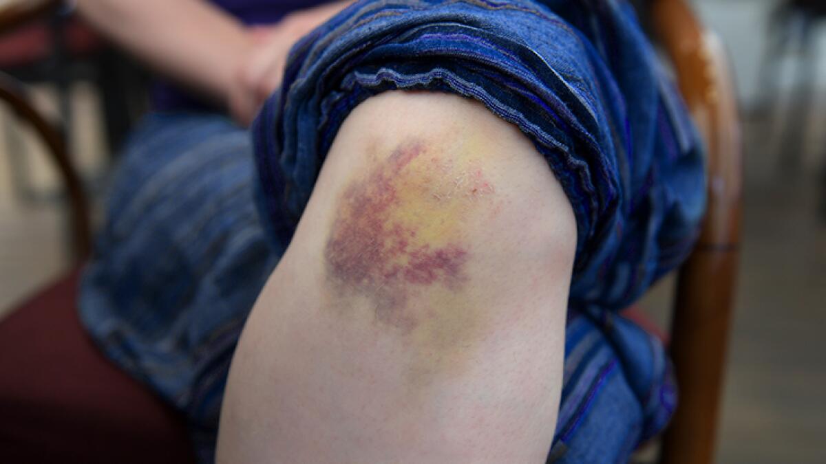 Bruise