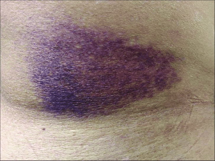 Ecchymosis