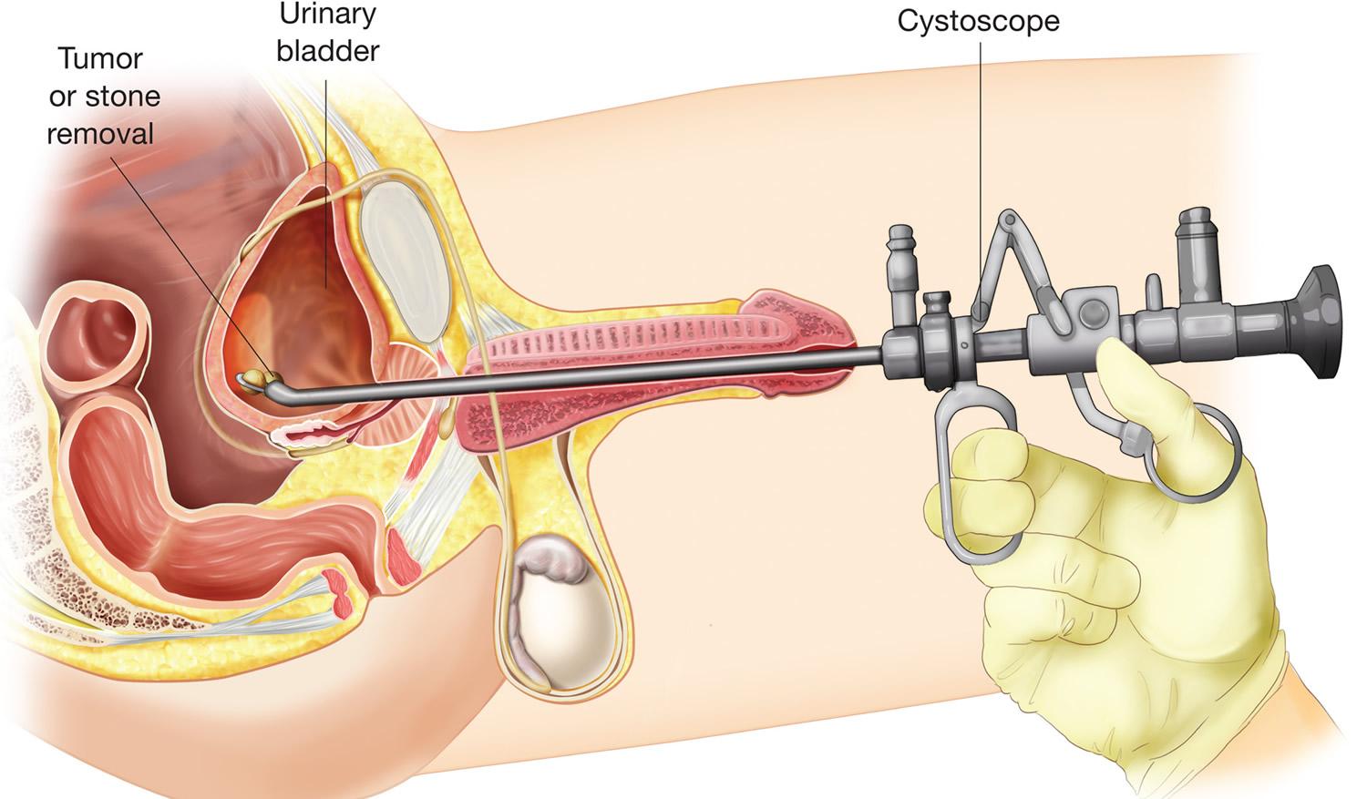 Cystoscopy 