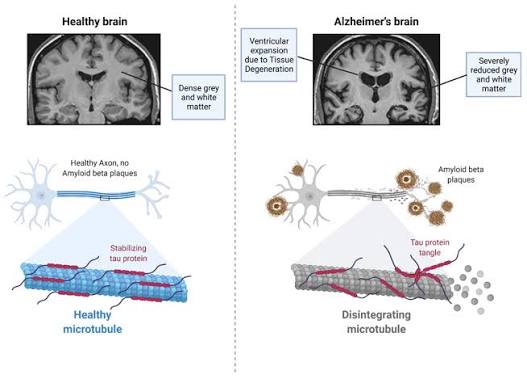 Difference between Healthy and Alzheimer’s affected brain 