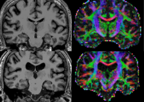 Brains of People With Chronic Fatigue Syndrome Shows Neurological Symptoms 