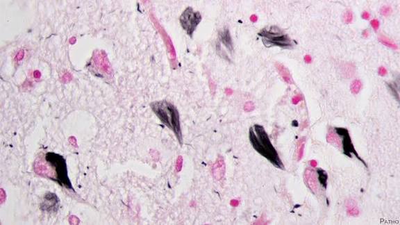Vaccines shows effectiveness in reducing neurofibrillary tangles, prominent signs of alzheimer’s