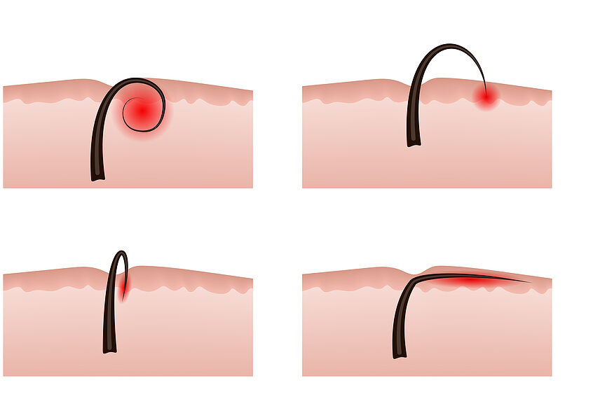 Consequences of Plucking or Tweezing Hair