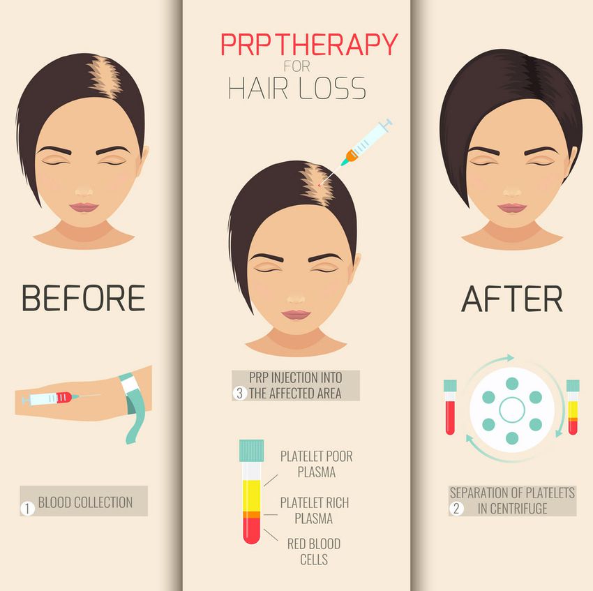 Effectiveness of PRP Therapy in Restoring Hair Growth 