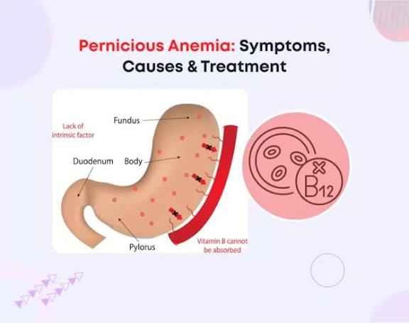 Vitamin Deficiency Anemia