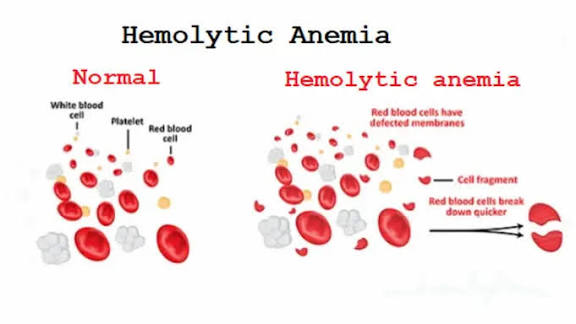 Hemolytic Anemia