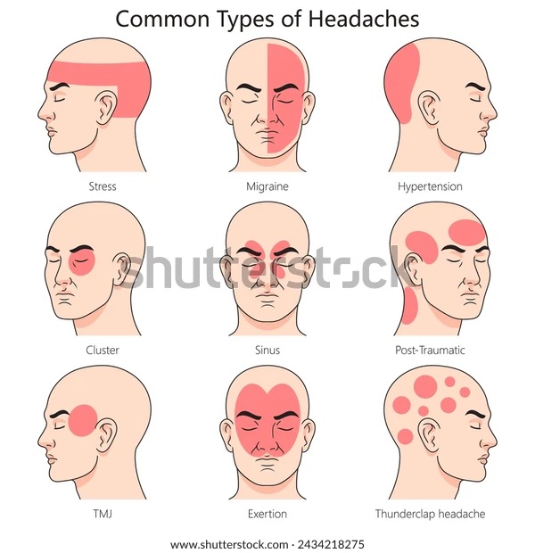 Areas affected by different types of headaches