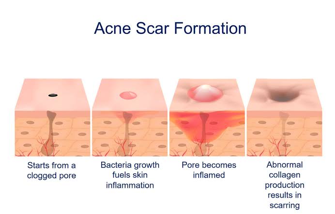 Process of developing Acne Scars