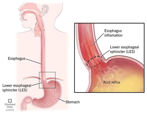 Closer look at Acid Reflux 