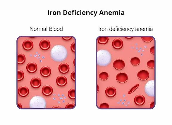 Clear Look of Iron Deficiency Anemia