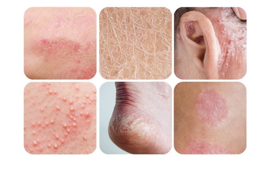 Identification Signs for Dry Skin 