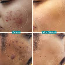 Clinically Proven Results of Plum Serum