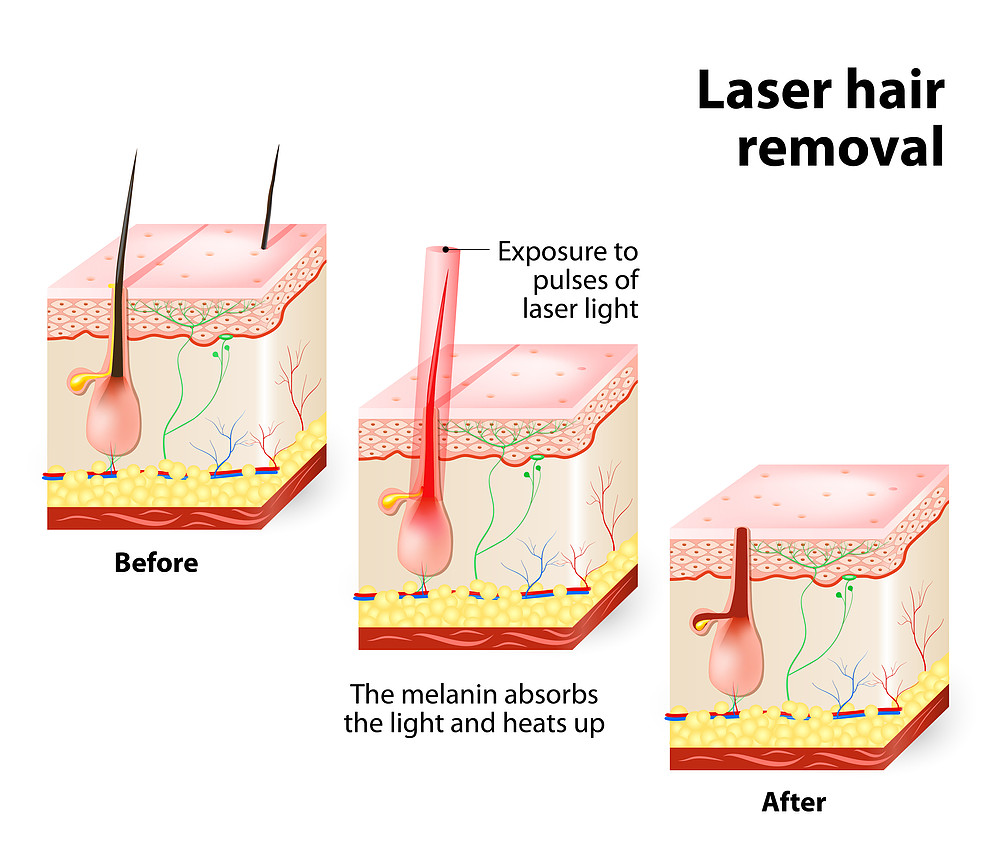 Laser Hair Removal Treatment 