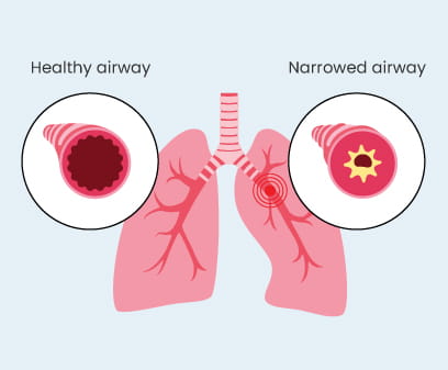 Difference between airway structure
