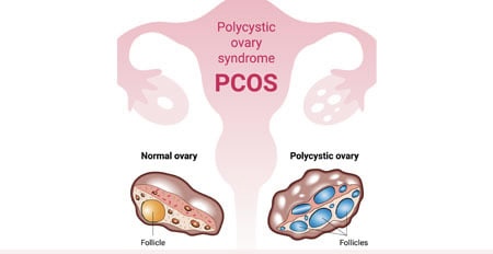 Overview of PCOS