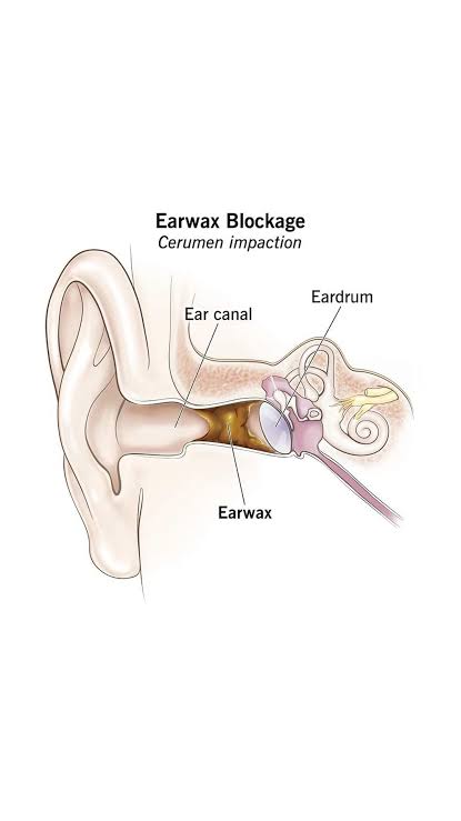 Earwax Blockage 
